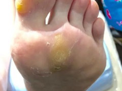 胼胝腳底有黃色繭子圖 胼胝腳底有黃色繭子圖