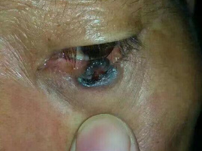 結節型黑色素瘤眼部黑色大疙瘩圖