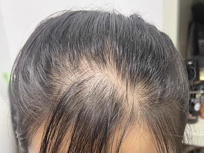 雄激素性脫髮頭髮逐漸變少圖