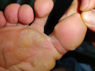 胼胝腳底有好幾個黃色的硬塊圖 胼胝腳底有好幾個黃色的硬塊圖