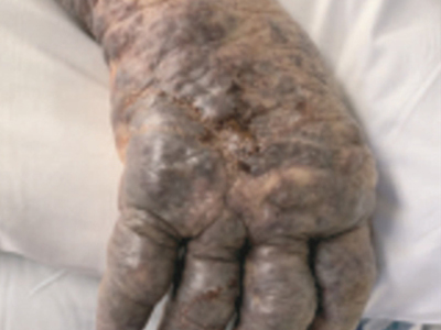 無綠藻病手部水腫顏色變黑圖 無綠藻病手部水腫顏色變黑圖