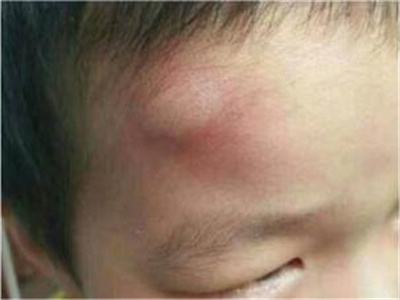 蚊子叮咬小孩額頭有個大包圖