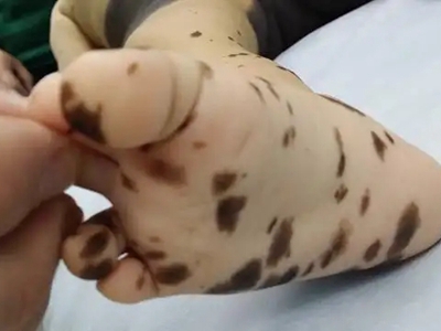 獸皮痣腳部有大小不等的黑斑圖
