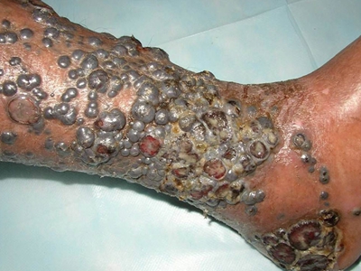 愛滋病皮膚腫瘤小腿部黑色結節圖