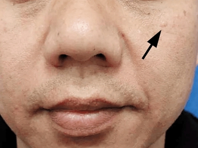 皮脂腺上皮瘤面部長一個小疙瘩圖