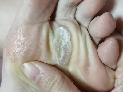 胼胝腳底橢圓形硬塊圖