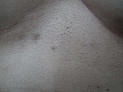 小棘毛壅病上腹部黑色丘疹圖