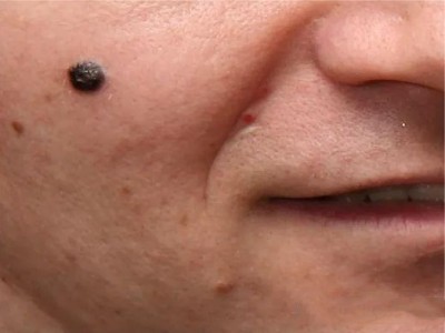 結節型黑色素瘤面部長黑色疙瘩圖