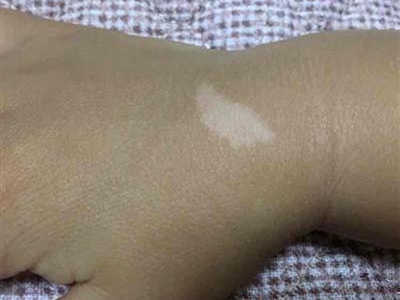 貧血痣手背上白了一塊圖