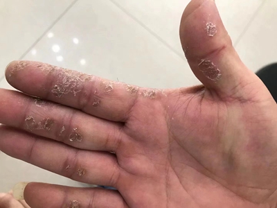 手部濕疹右手手指處脫皮結痂圖 手部濕疹右手手指處脫皮結痂圖