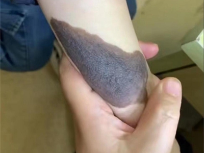 獸皮痣胳膊上有一片粗糙黑斑圖