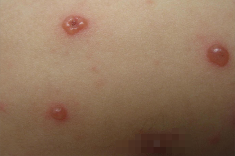 種痘樣水皰病胸部長了水皰結痂圖 種痘樣水皰病胸部長了水皰結痂圖