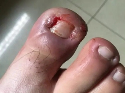 嵌甲拇趾腫脹甲緣流血圖