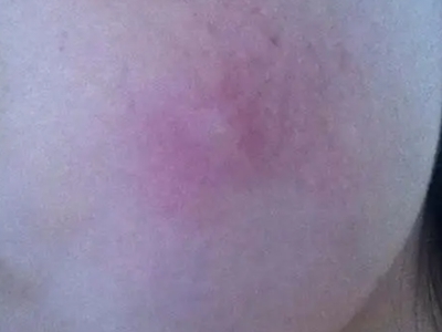 蠓蟲叮咬臉上有紅疙瘩圖