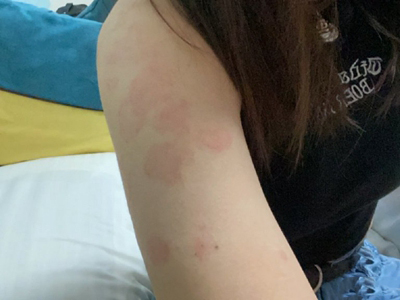 海鮮過敏胳膊好幾片紅斑圖