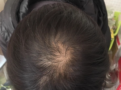 雄激素性脫髮頭頂有一小塊脫髮圖 雄激素性脫髮頭頂有一小塊脫髮圖