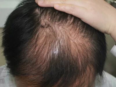 男性型脫髮頭頂頭髮纖細稀疏圖
