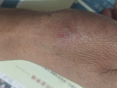 手部濕疹手部發紅掉皮圖 手部濕疹手部發紅掉皮圖