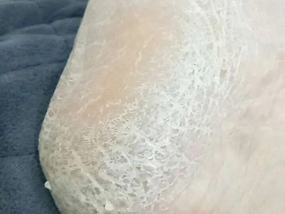 手足皸裂腳後跟乾燥裂紋圖 手足皸裂腳後跟乾燥裂紋圖