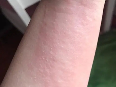 海鮮過敏胳膊上有小紅疙瘩圖 海鮮過敏胳膊上有小紅疙瘩圖
