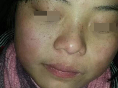 雀斑面部有較多的褐色斑點圖 雀斑面部有較多的褐色斑點圖