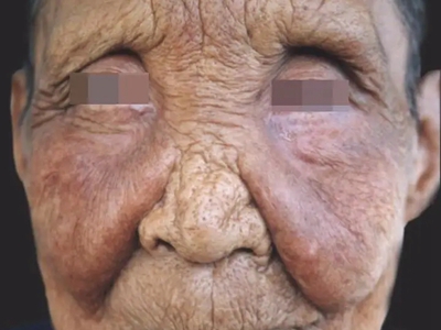 三期梅毒鼻部塌陷變形圖