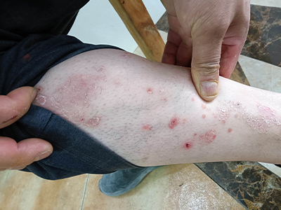 尋常型銀屑病小腿上起丘疹圖