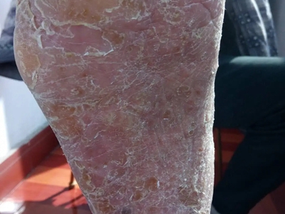 皰疹樣膿皰病腳底大面積脫皮圖