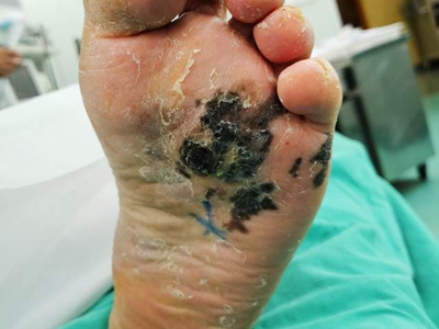 原位惡性黑色素瘤腳底一片黑斑圖 原位惡性黑色素瘤腳底一片黑斑圖