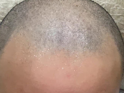雄激素性脫髮頭皮髮際線後移圖 雄激素性脫髮頭皮髮際線後移圖