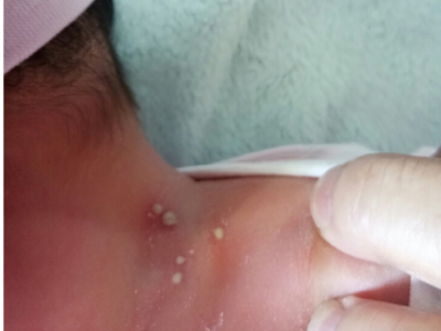 新生兒膿皰瘡後頸出現幾個膿包圖 新生兒膿皰瘡後頸出現幾個膿包圖