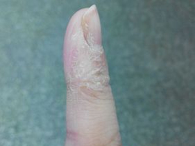 手部濕疹手指癢脫皮圖