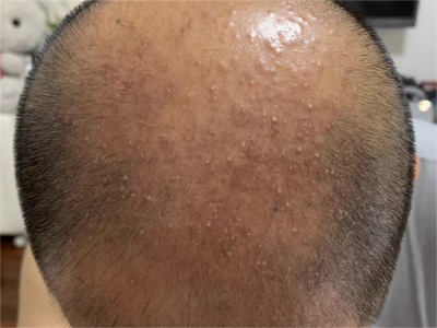 雄激素性脫髮頭頂脫髮長疙瘩圖 雄激素性脫髮頭頂脫髮長疙瘩圖