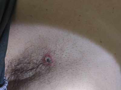 恙蟲病腋窩下潰瘍圖 恙蟲病腋窩下潰瘍圖
