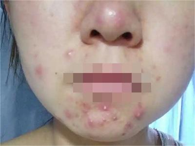 化妝品性痤瘡口周有小丘疹圖 化妝品性痤瘡口周有小丘疹圖