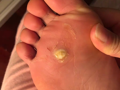 胼胝腳底有個黃色粗糙的硬塊圖