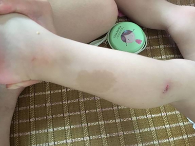 咖啡斑腿上淡褐色斑片圖 咖啡斑腿上淡褐色斑片圖