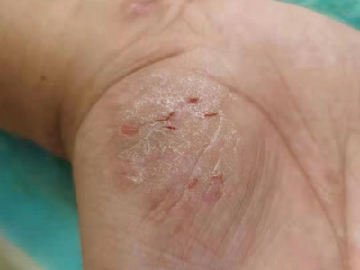 手部濕疹右手大魚際有白色皮屑圖 手部濕疹右手大魚際有白色皮屑圖