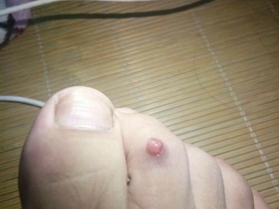 小汗腺汗孔瘤腳趾上長小紅疙瘩圖