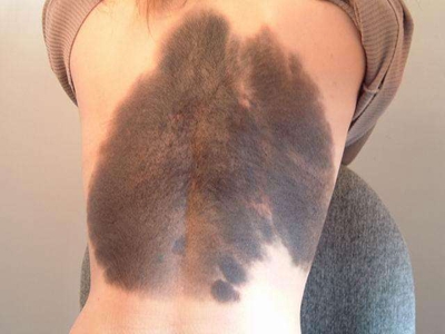 獸皮痣背部一大片黑皮上面長毛圖 獸皮痣背部一大片黑皮上面長毛圖