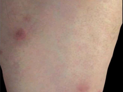 嗜酸性脂膜炎大腿有大紅疙瘩圖
