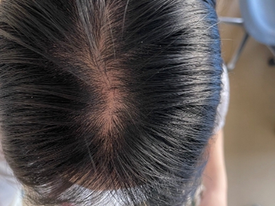 女性型脫髮頭頂發縫明顯增寬圖