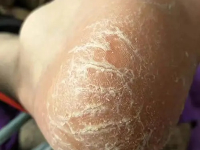 手足皸裂腳後跟乾燥脫皮裂口子圖