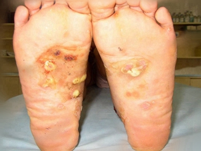 三期梅毒腳底有潰瘍膿包圖 三期梅毒腳底有潰瘍膿包圖