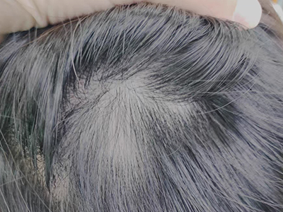 女性型脫髮頭皮上頭髮稀疏圖 女性型脫髮頭皮上頭髮稀疏圖