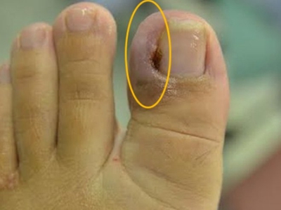 嵌甲大腳趾甲邊緣紅腫結血痂圖
