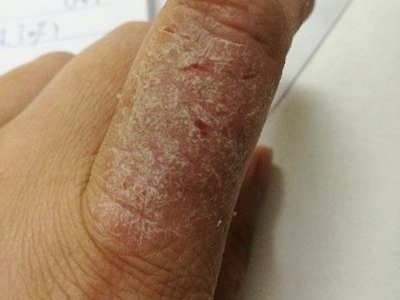 手部濕疹食指脫屑裂口圖 手部濕疹食指脫屑裂口圖