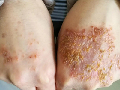 手部濕疹手背有黃色結痂圖 手部濕疹手背有黃色結痂圖