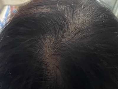 女性型脫髮頭頂發縫頭髮稀疏圖 女性型脫髮頭頂發縫頭髮稀疏圖