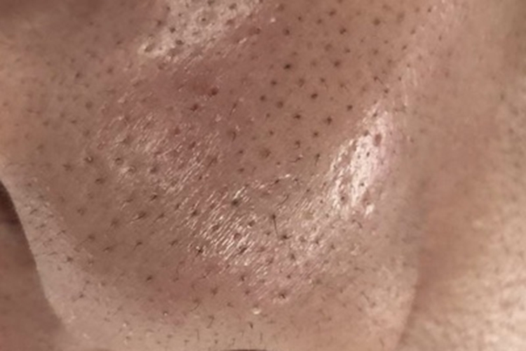 小棘毛壅病面部黑色丘疹圖 小棘毛壅病面部黑色丘疹圖